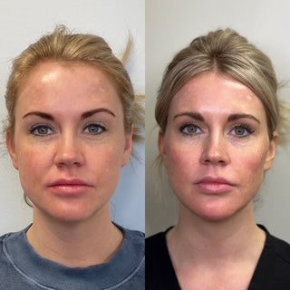 Facial Balancing & Volume Restoration Bundle
