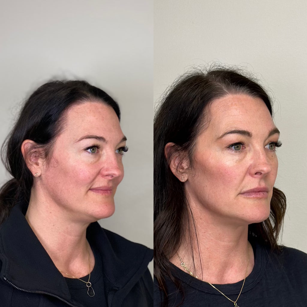 Facial Balancing & Volume Restoration Bundle