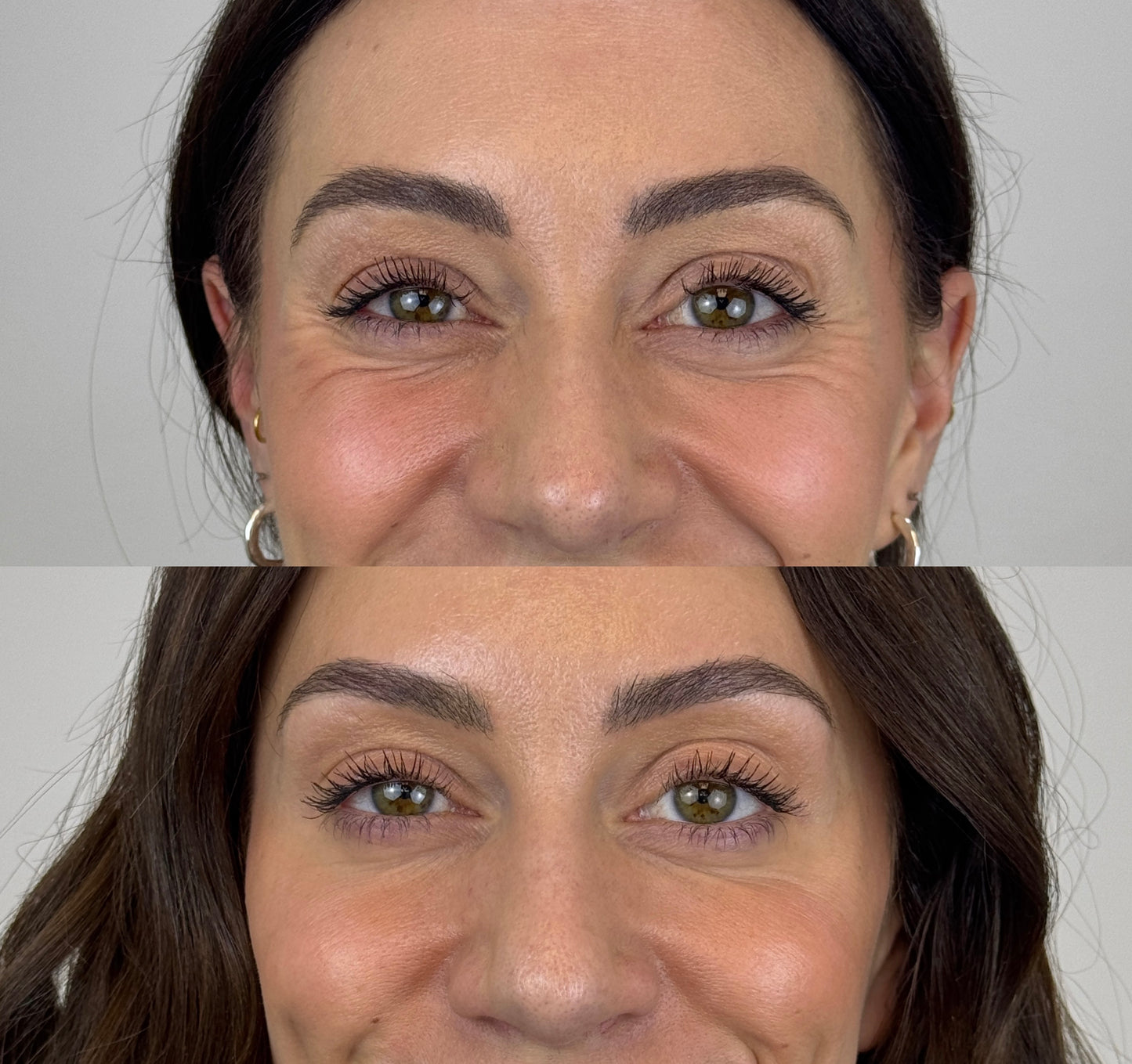 Injectables