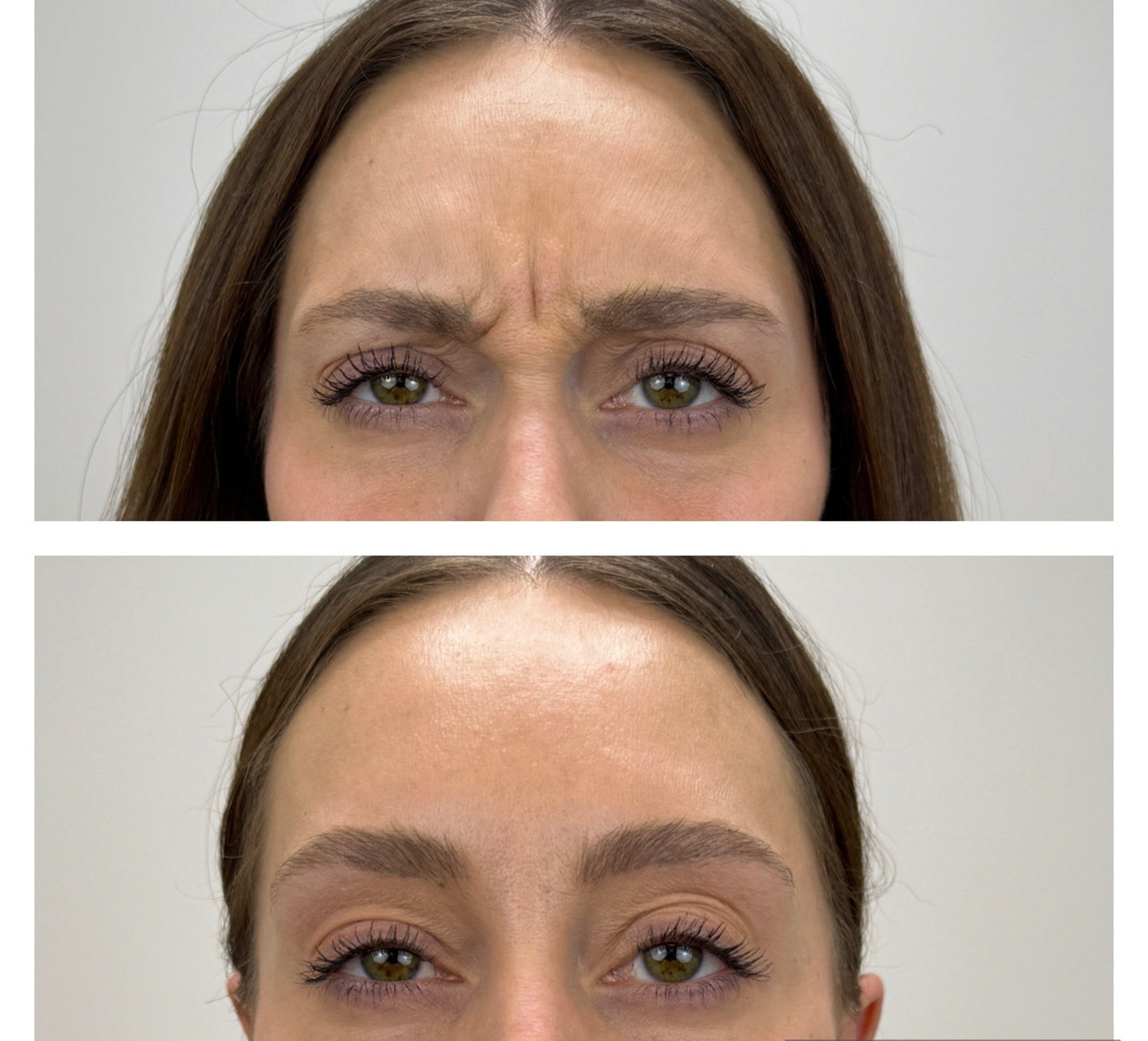 Injectables