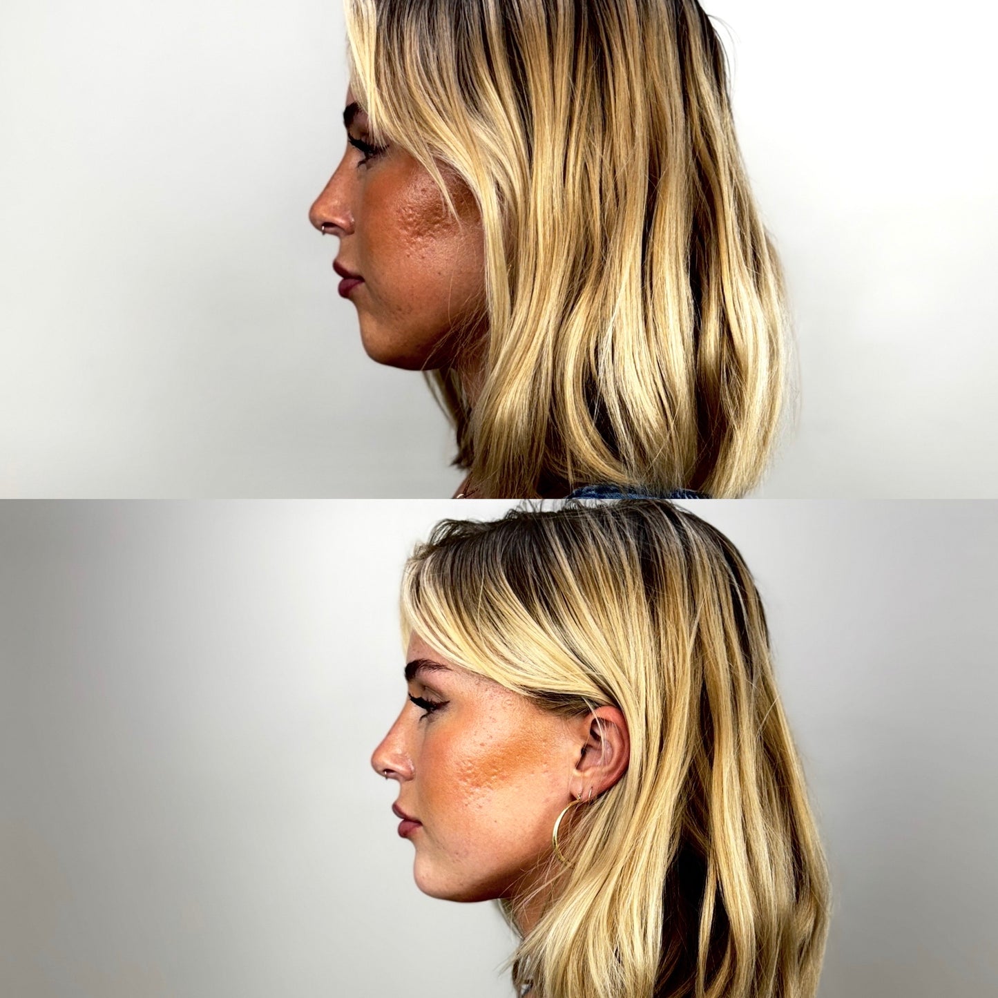 Facial Balancing & Volume Restoration Bundle