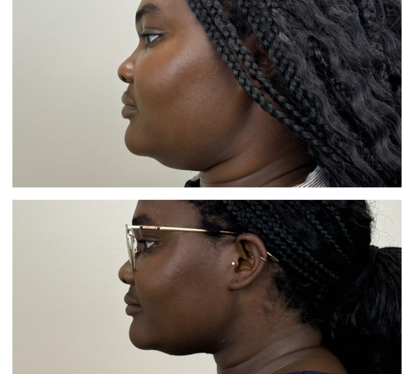 Kybella - Liposculpt