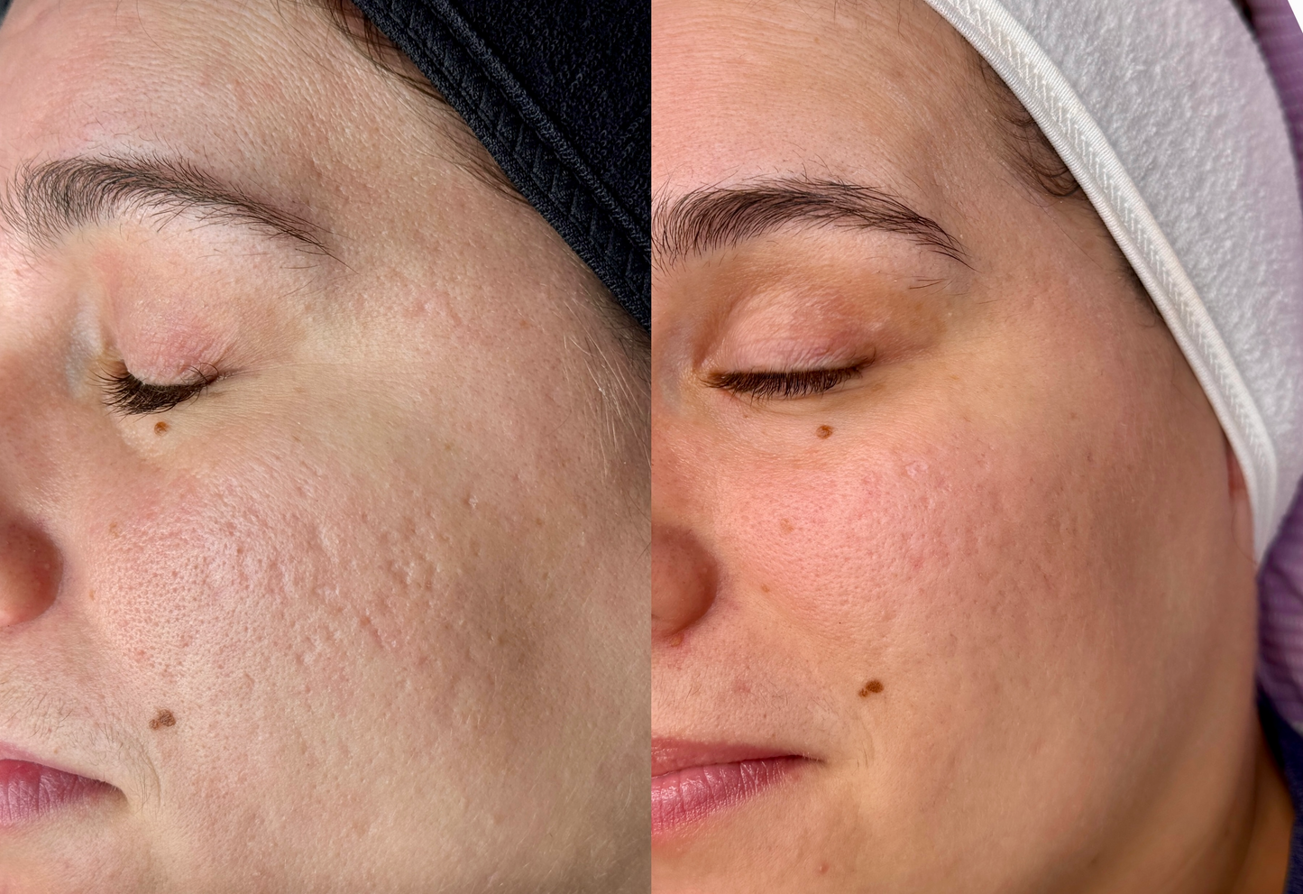 Microneedling
