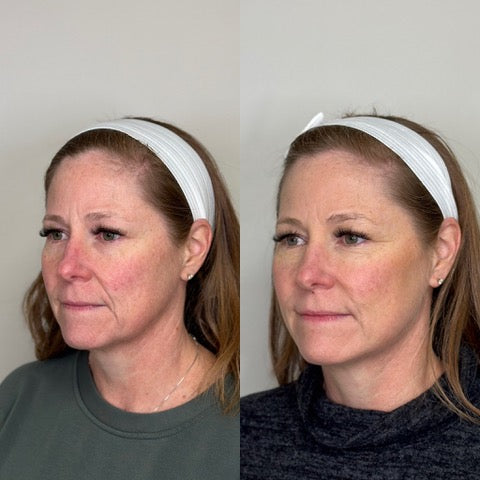 Side profile comparison showing before and after of PDO Threads at Bloom Aesthetics with lifted and tightened skin