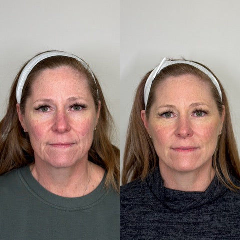 Before and after for PDO Threads at Bloom Aesthetics showing sagging to lifted skin and more youthful appearance