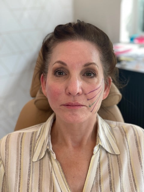 Client treatment prep for PDO Threads at Bloom Aesthetics showing cheek areas where threads will be placed to rejuvenate sagging skin
