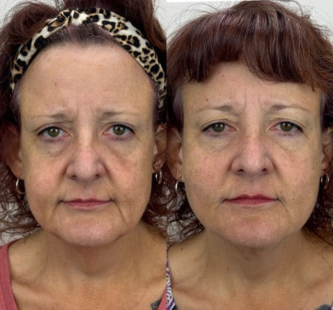 Before and after for PDO Threads at Bloom Aesthetics showing reduced fine lines and wrinkles and rejuvenated facial appearance