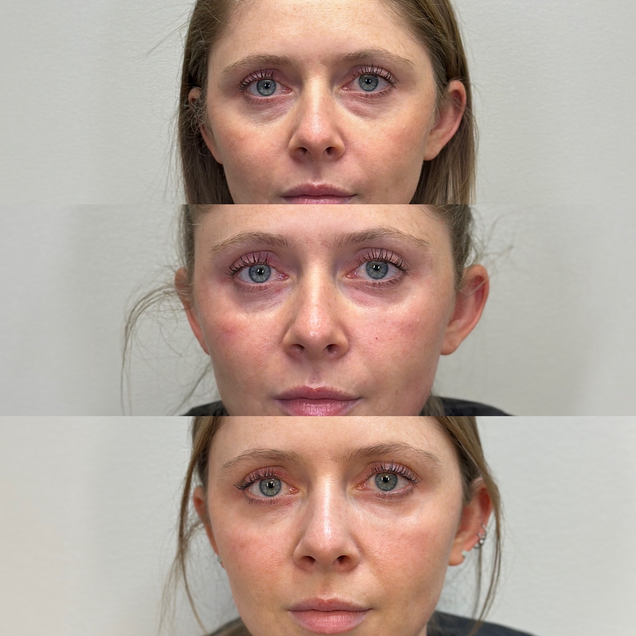 Before and after for PRF at Bloom Aesthetics from undereye darkness and hollowing to youthful, radiant complexion using platelet-rich fibrin