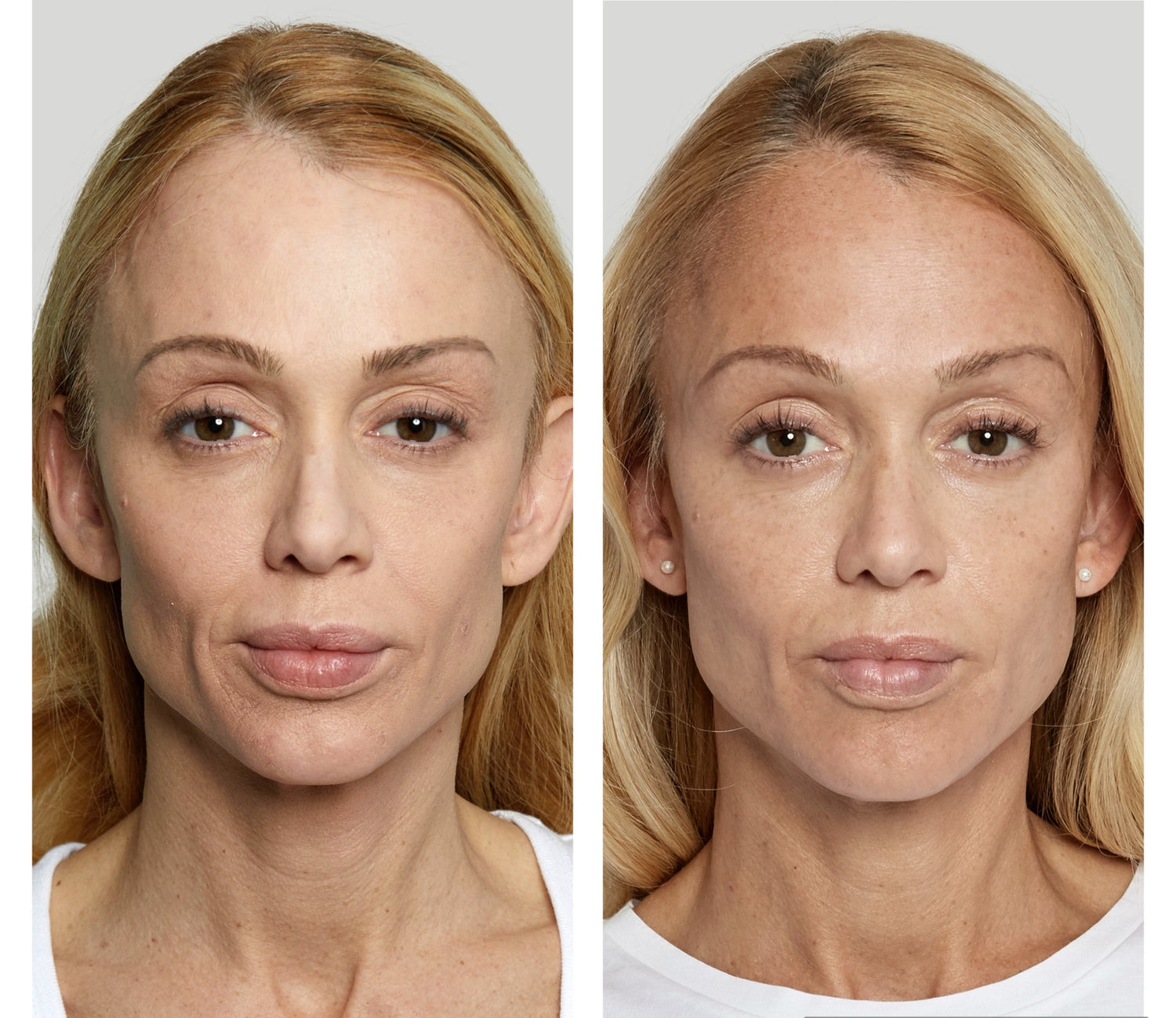 Before and after of Sculptra treatment at Bloom Aesthetics, from hollow areas to fuller, radiant facial appearance