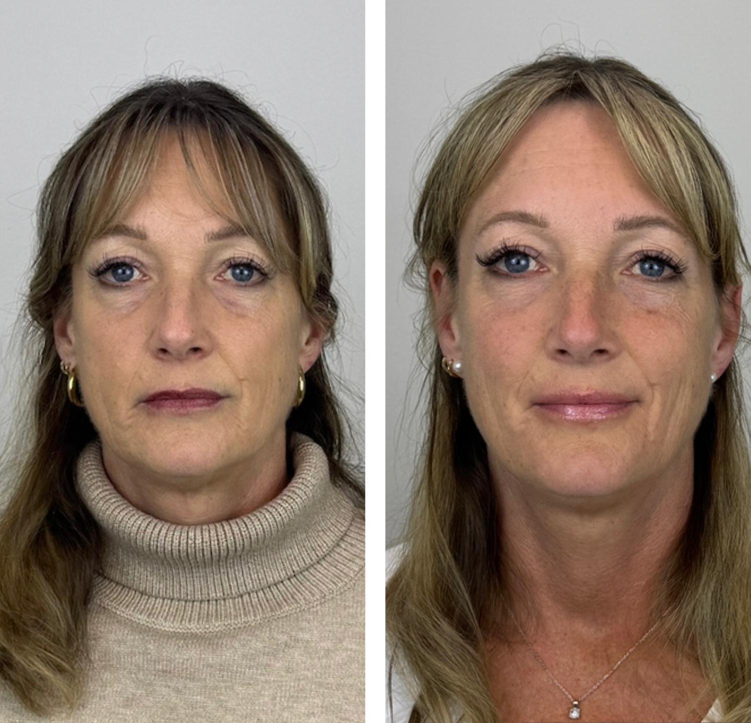 Before and after for Sculptra at Bloom Aesthetics, showing smoother, lifted skin