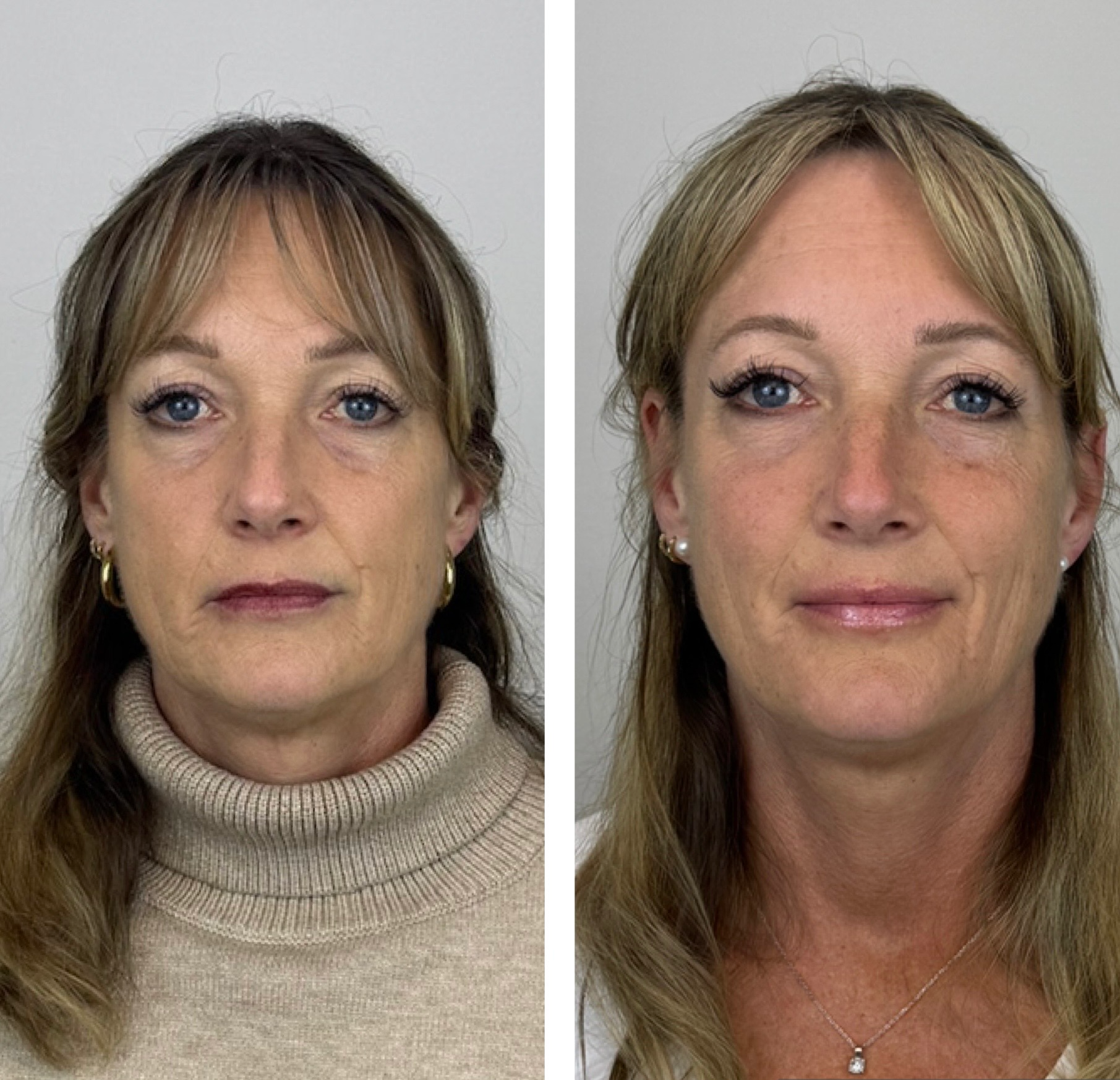 Before and after for Sculptra at Bloom Aesthetics, showing smoother, lifted skin