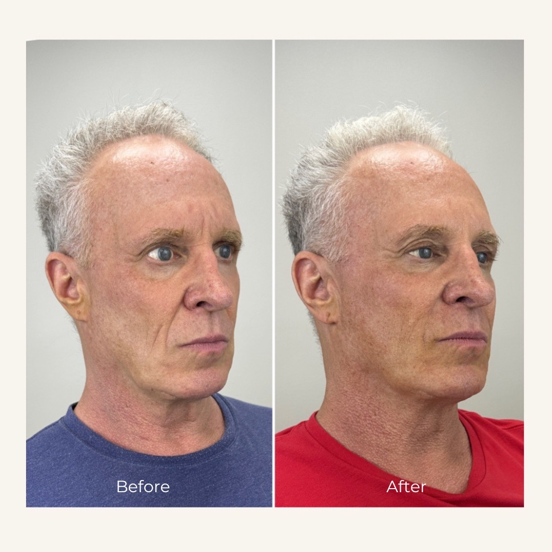 Before and after for PDO Threads and Sculptra for male client at Bloom Aesthetics with fewer lines and relaxed facial appearance