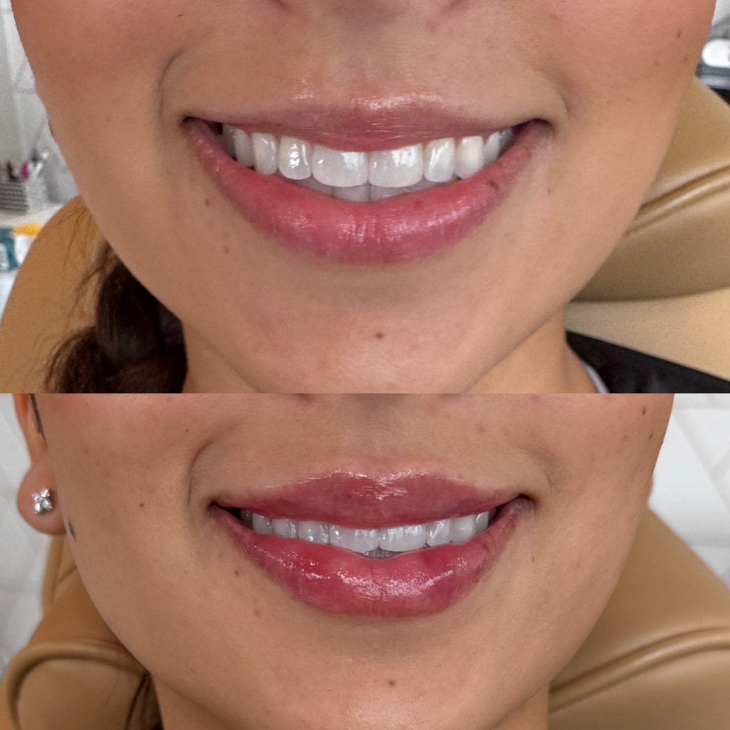 Fillers