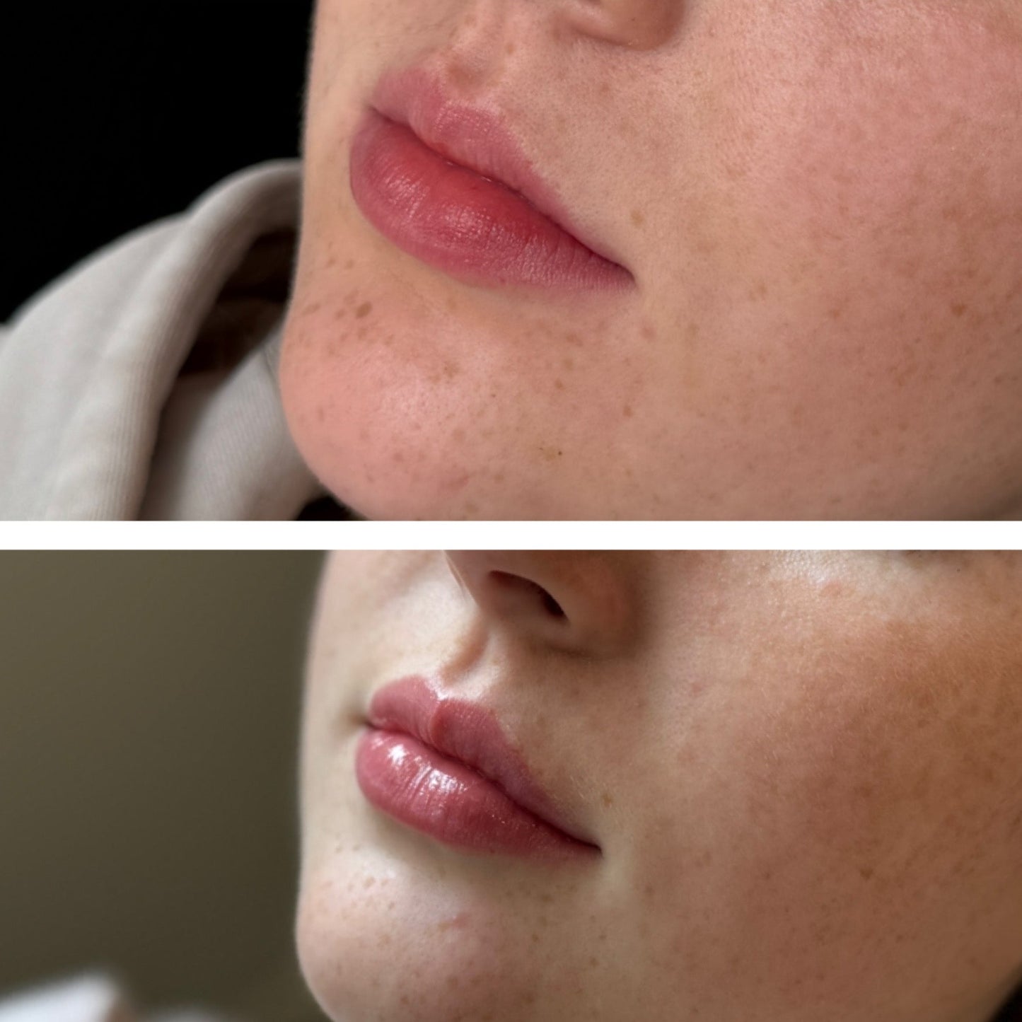 Fillers