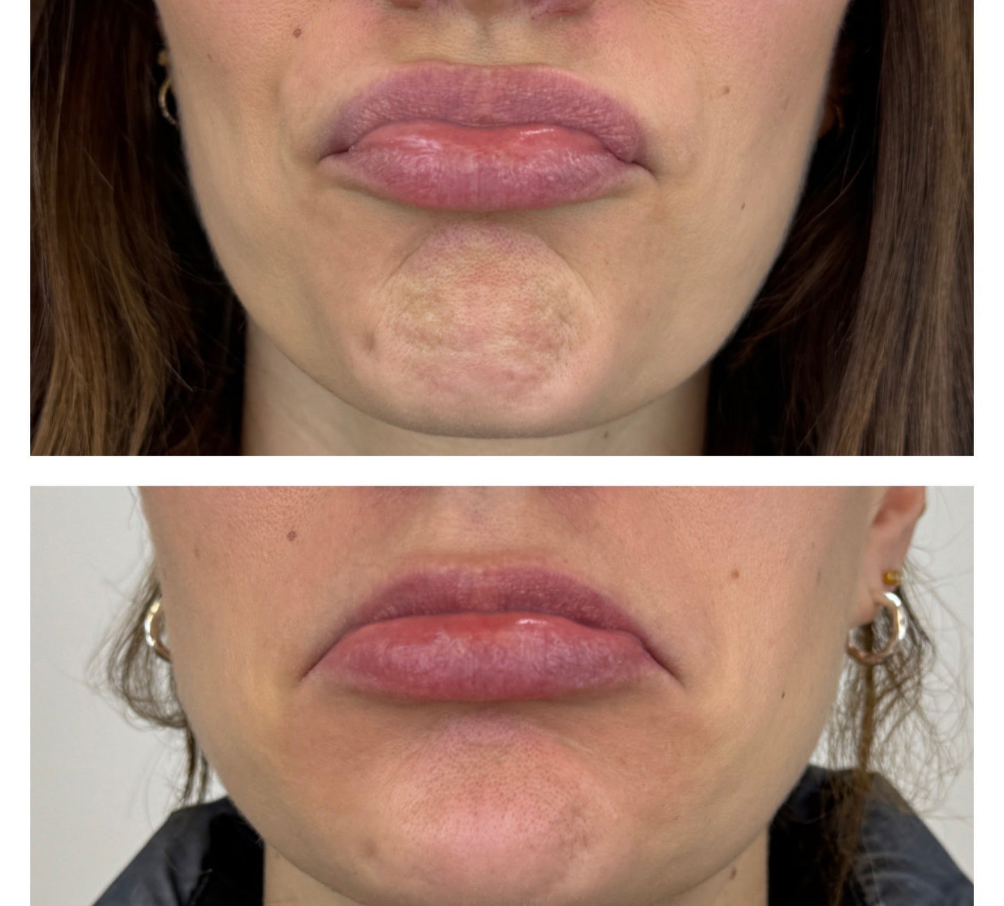 Injectables