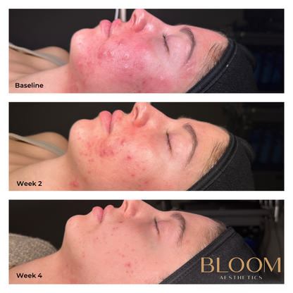 Acne Bootcamp
