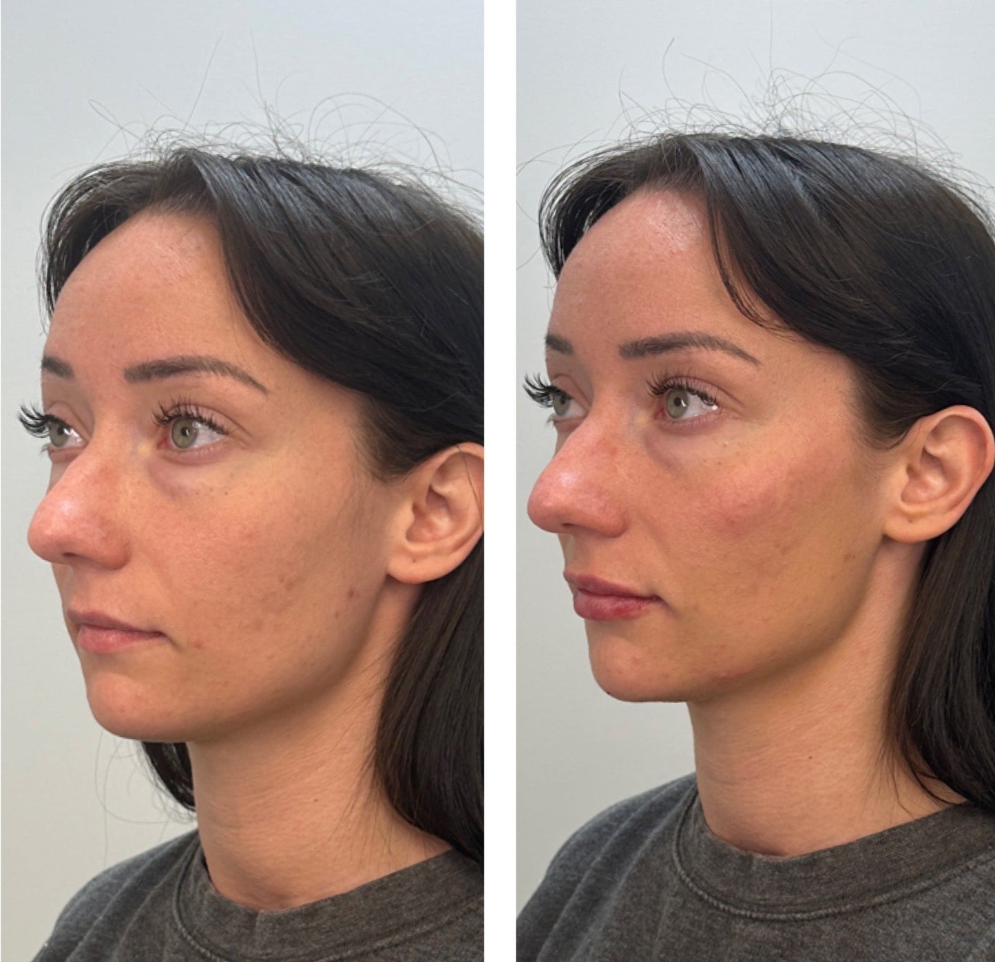 Facial Balancing & Volume Restoration Bundle