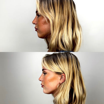 Facial Balancing & Volume Restoration Bundle
