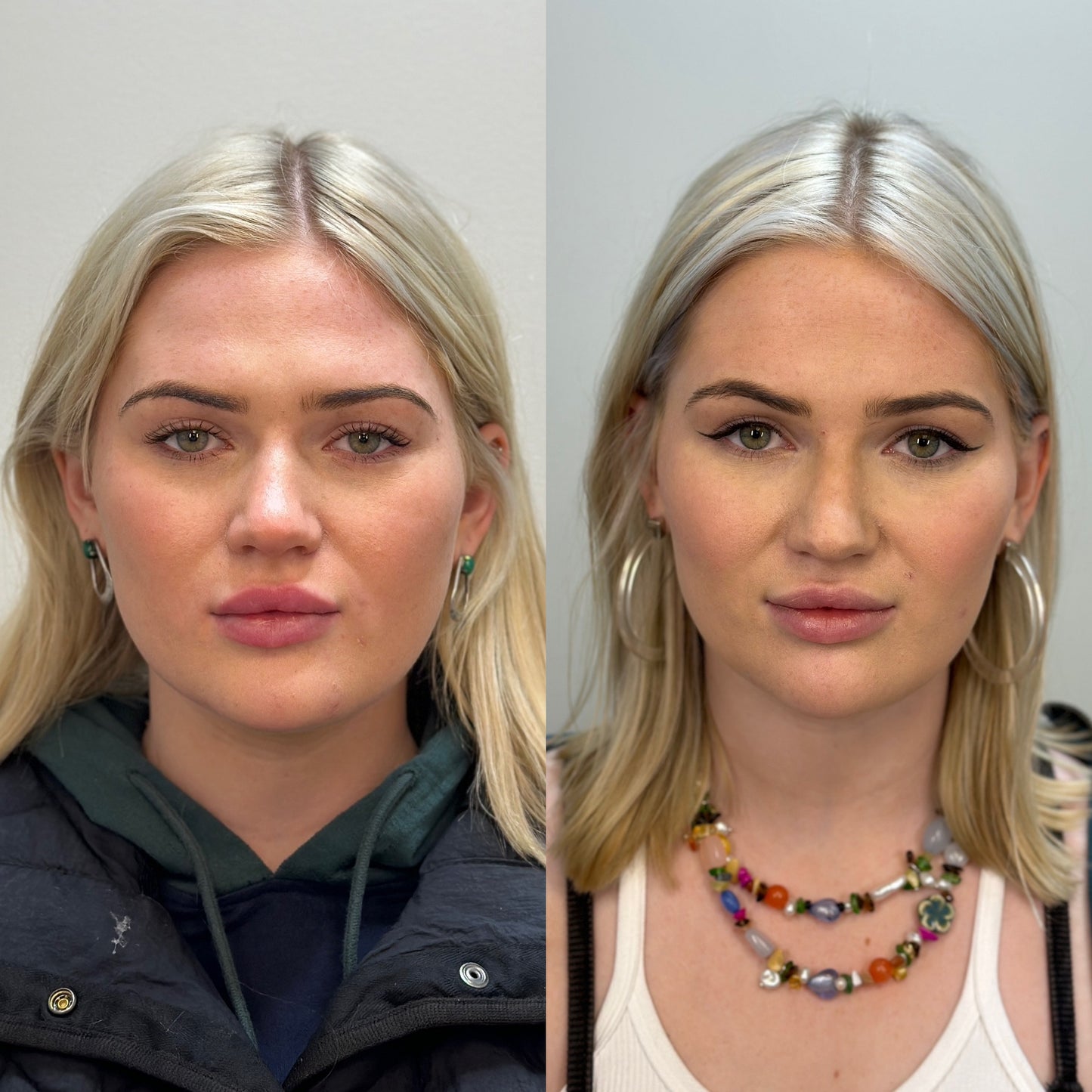 Facial Balancing & Volume Restoration Bundle