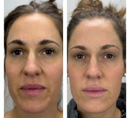 Microneedling