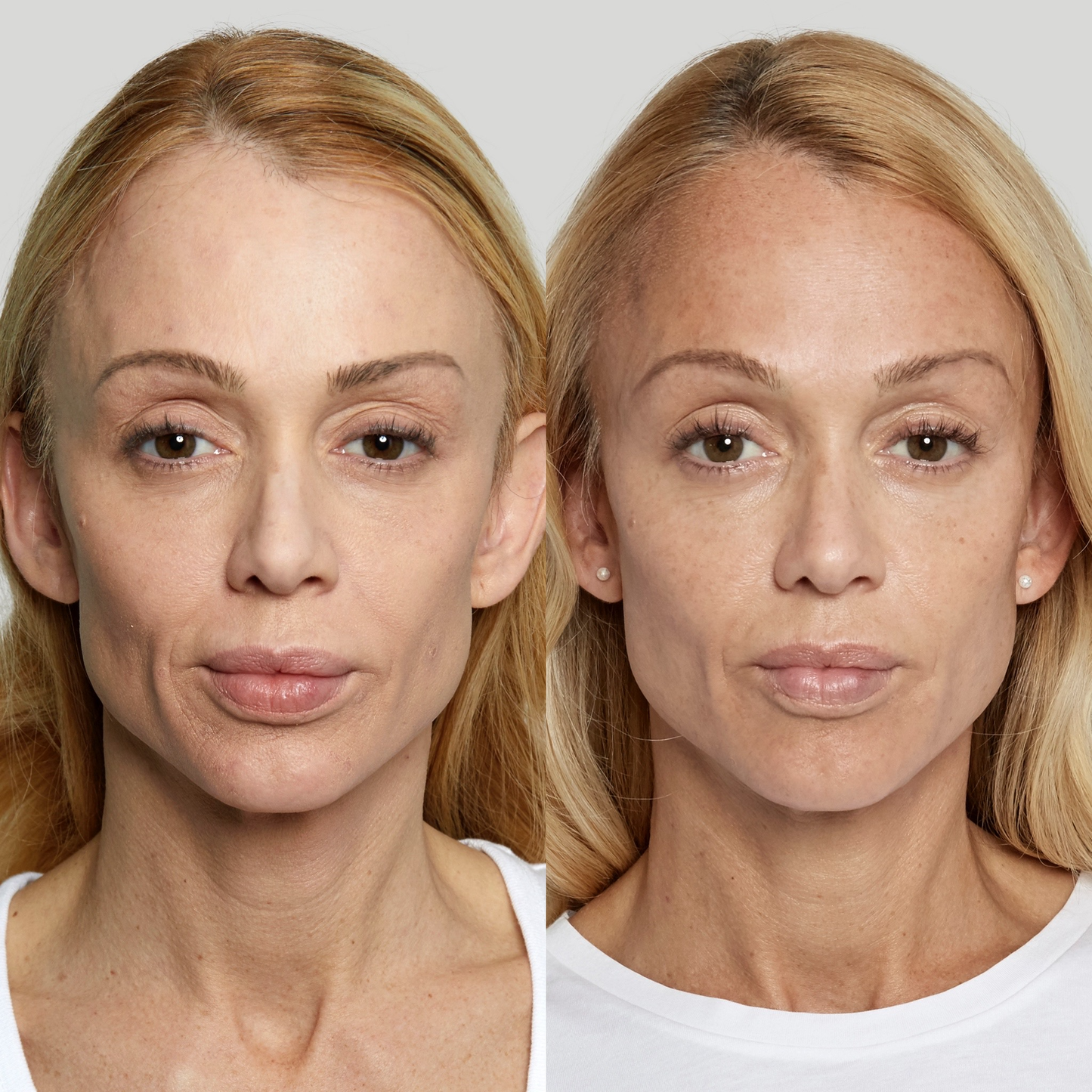Sculptra